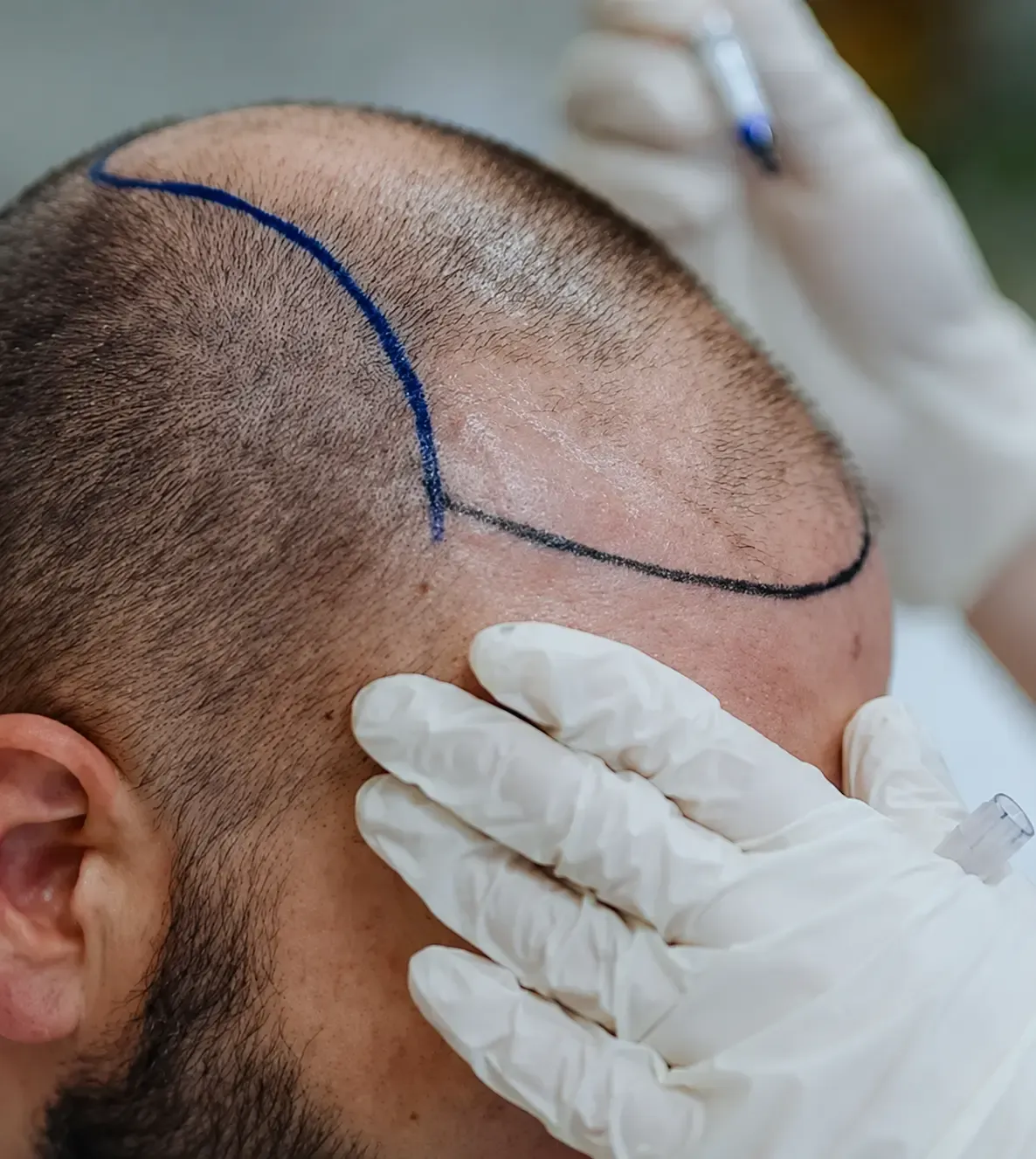 Hair transplantation procedure being performed at Luxskin