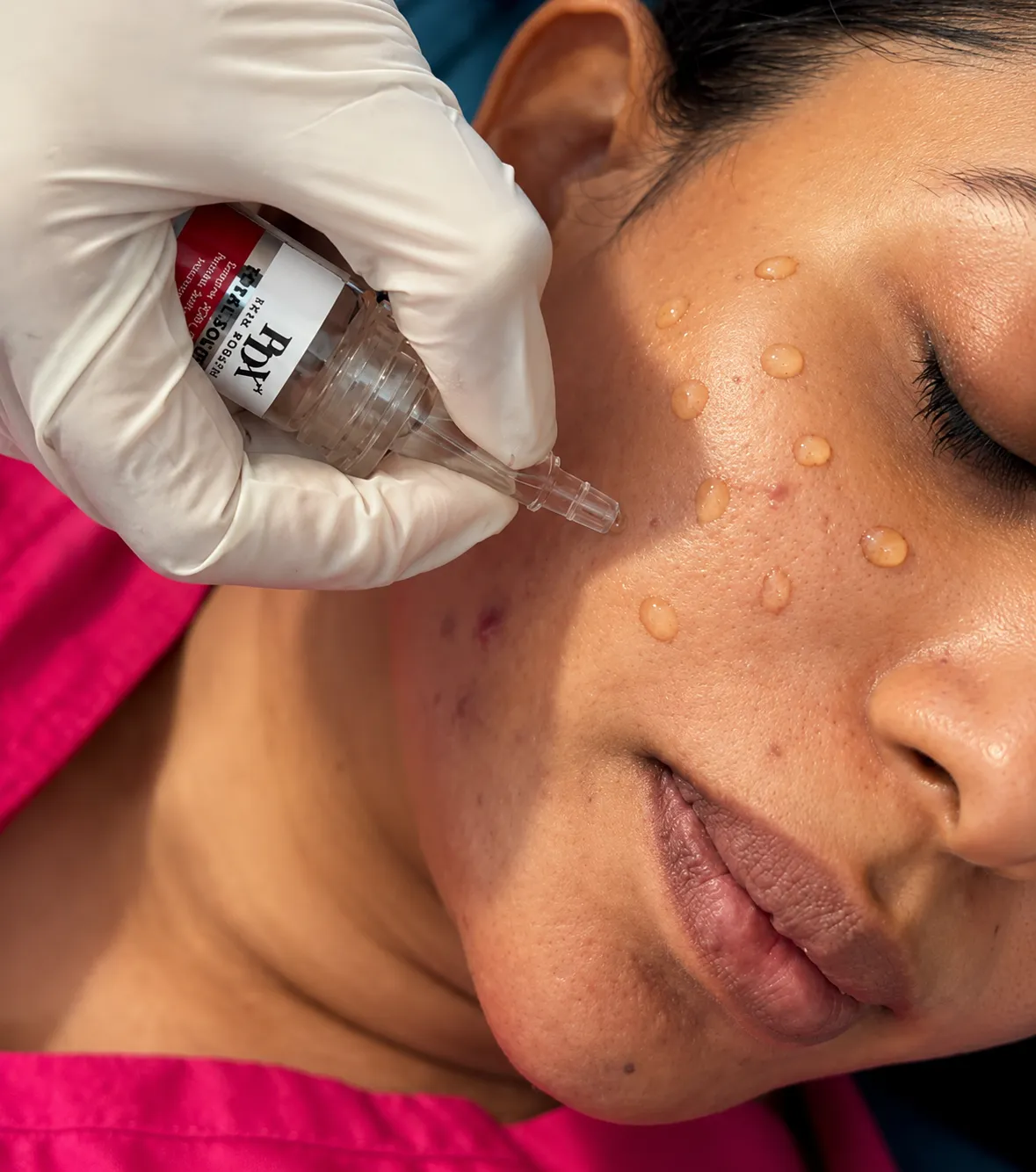 Skin rejuvenation treatment done by luxskin