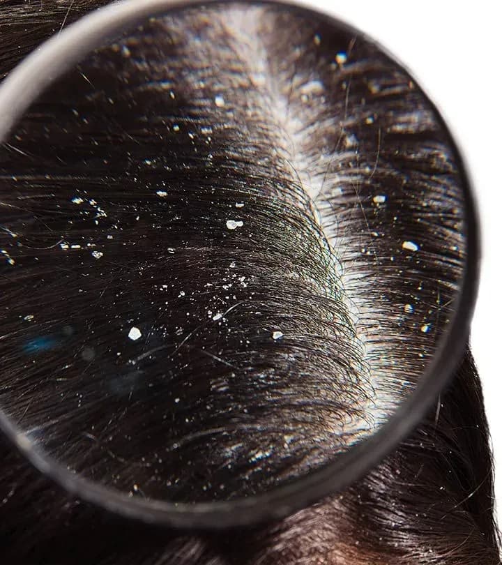 Dandruff clearing scalp treatment at Luxskin for a healthy, flake-free scalp