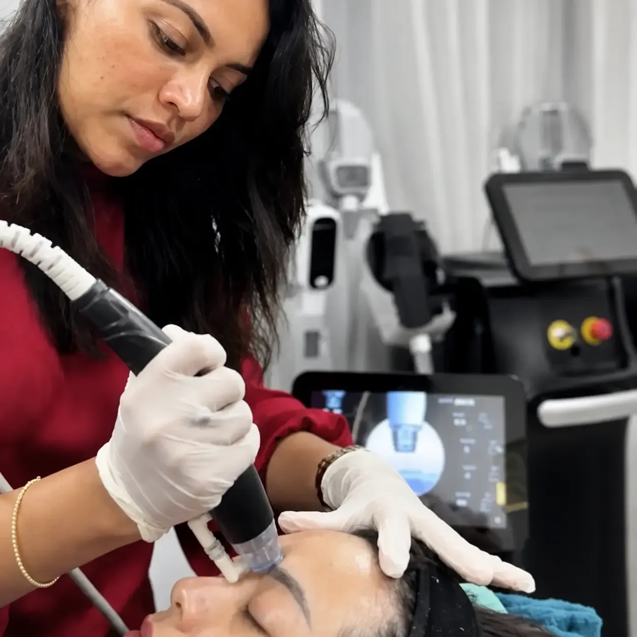 Dr Dineli performing a microneedling treatment with a sterile motorised medical pen on a patient at Luxskin clinic in Colombo