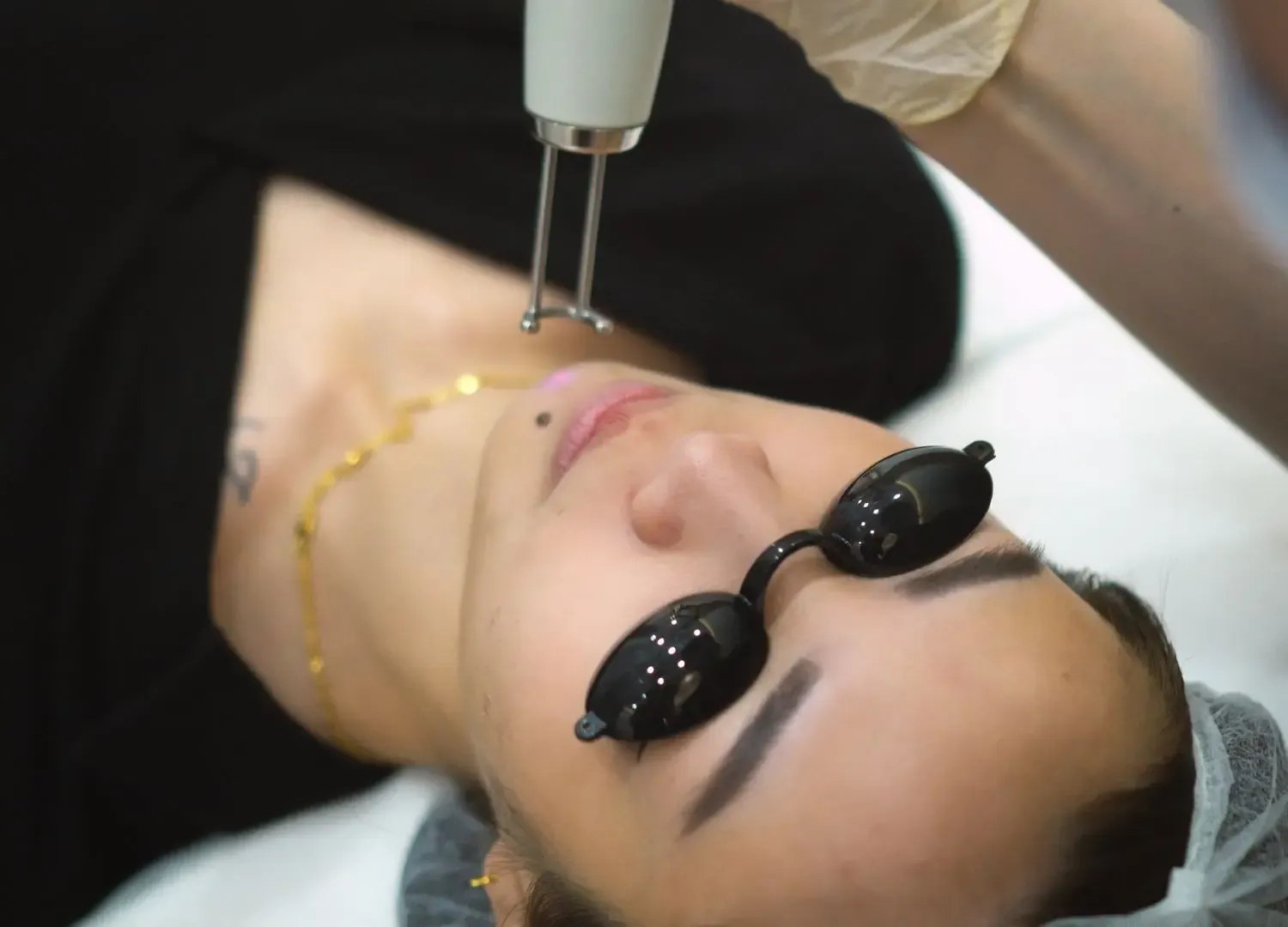 Pico laser treatment being administered on a patient's face with protective eyewear at Luxskin