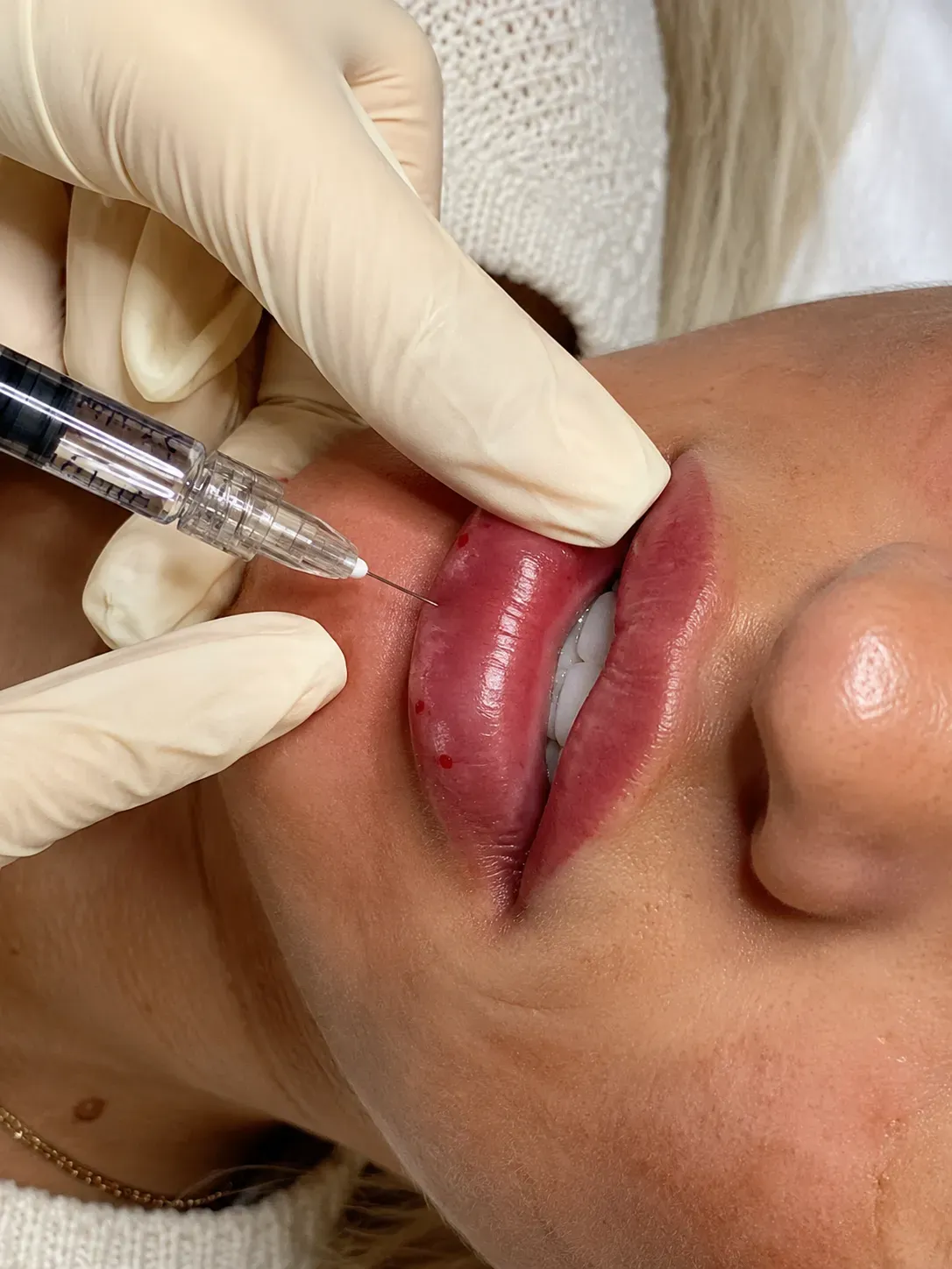 Luxskin lip filler treatment